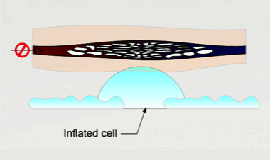 pressure sore, pressure ulcer, decubitus ulcer, alternating pressure mattress, mattress overlay, small cells, operating room ulcer prevention, pressure ulcer prevention, decubitus ulcer prevention, Medicare, Medicaid